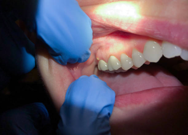 Best Emergency Dentist for Knocked-Out Tooth in Scranton, PA
